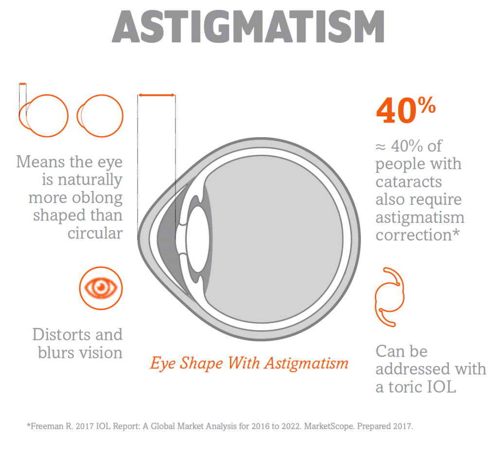 Illustrated diagram explaining astigmatism