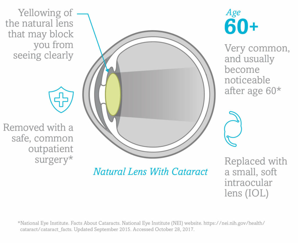 A diagram showing the effects of a cataract