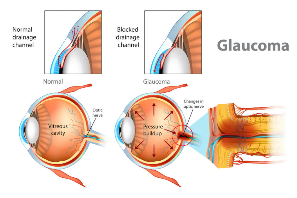 Illustrated diagram of effects and cause of glaucoma