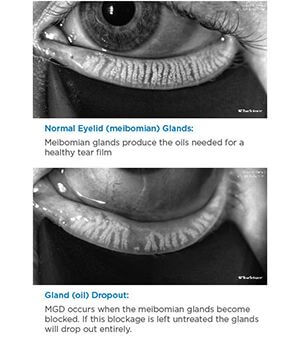 Example of normal eye and an eye that has a blocked melbomian gland