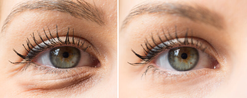 Before and after eyelid surgery