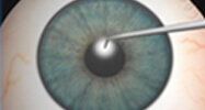 Intacts corneal implants step-1