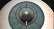 Intacts corneal implants step-2