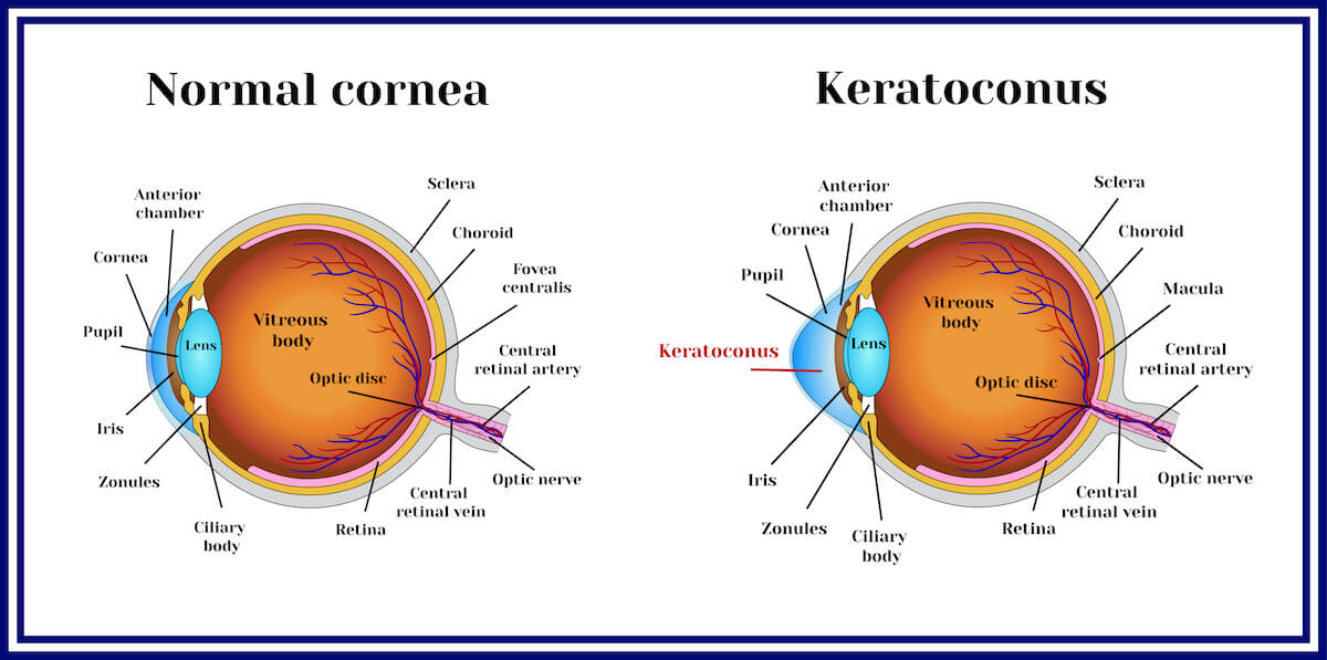 Keratoconus. Dystrophic disease of the cornea.