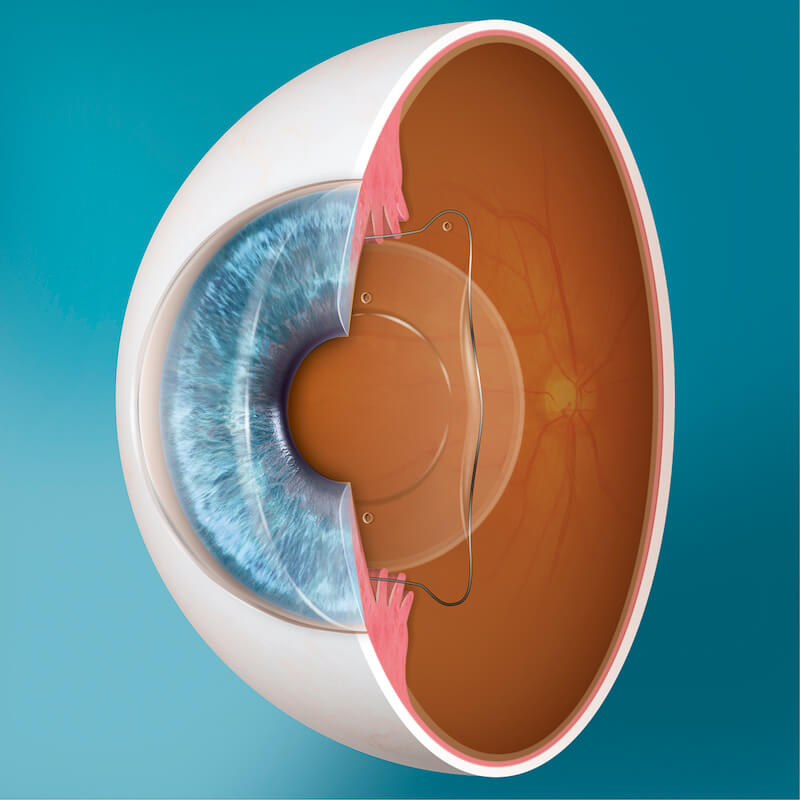 Illustrated diagram showing a cross section of an eye with a Visian ICL in it
