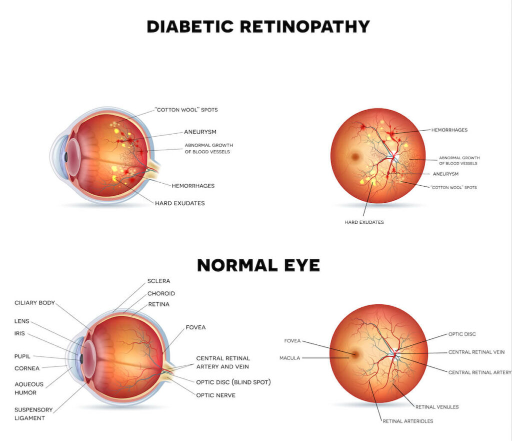 Diabetic retinopathy on a white background, detailed anatomy.