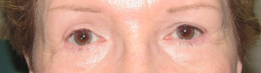 Closeup of a patient before having oculoplastic surgery