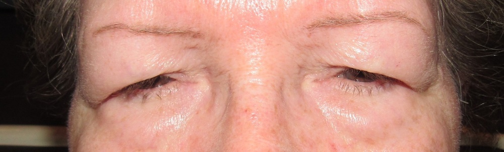 Closeup of patients eyes before having oculoplastic surgery